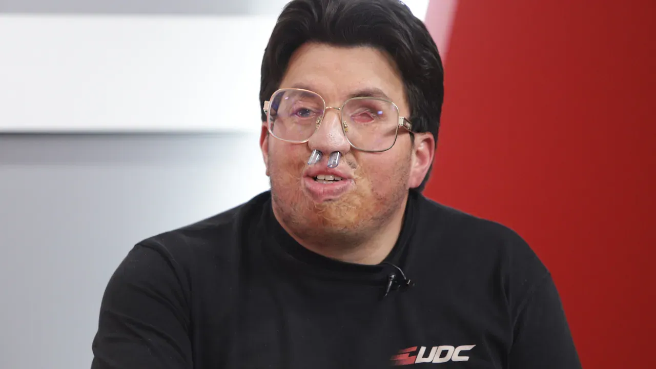 Sergio Mogollón, víctima de ataque con ácido, recibirá ayuda del presidente De La Espriella